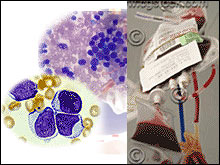 มะเร็งเม็ดเลือดขาว - ลิวคีเมีย, ลูคีเมีย, Leukemia