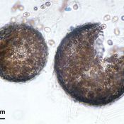 เชื้อรามรณะPseudallescheria boydii