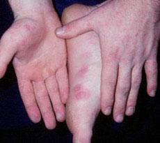 โรคมือเท้าปาก Hand foot and-mouth disease (HFMD)