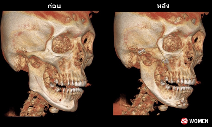 ไวส์ อดีตมิสทิฟฟานี่